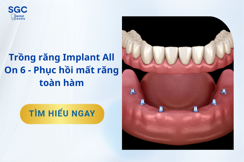 Dịch vụ Trồng răng Implant All On 6