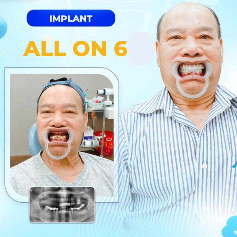 Dịch vụ Trồng răng Implant All On 6